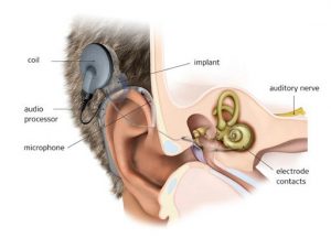 cochlear-implants-part-how-it-works-1